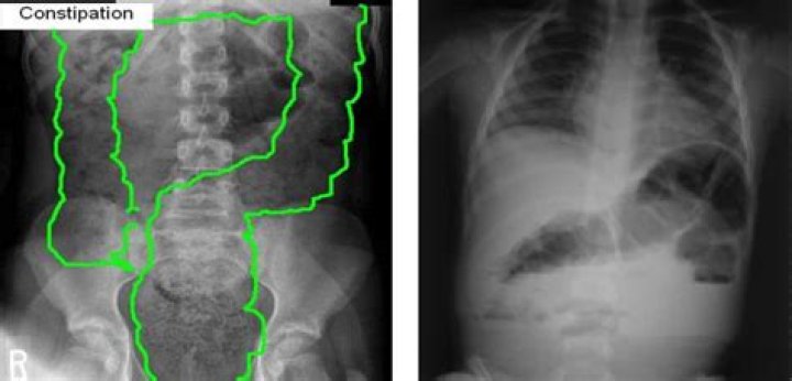Can you pass gas if constipated?