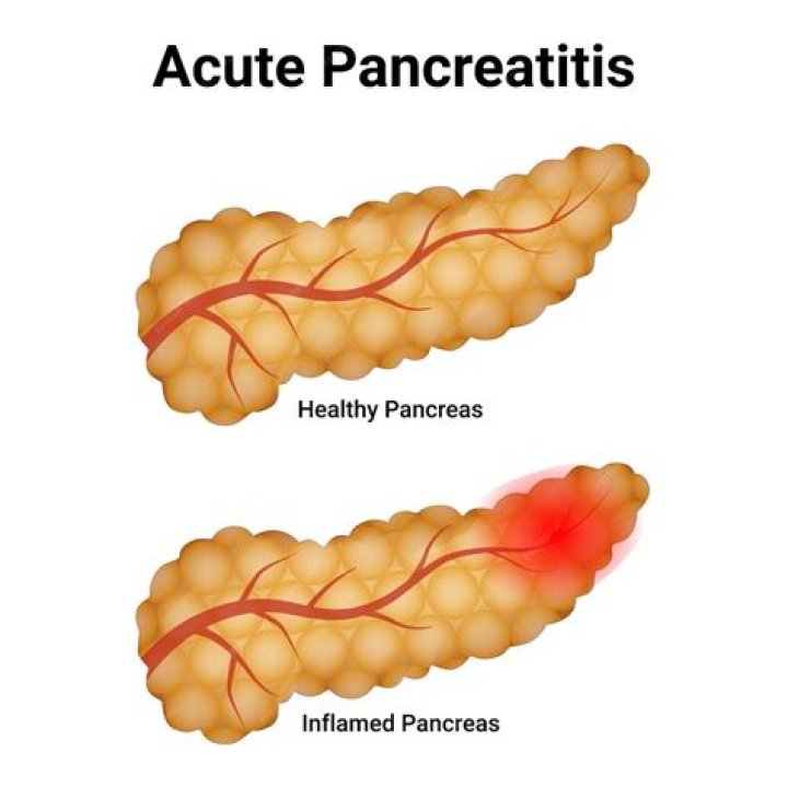 How do you treat an inflamed pancreas?
