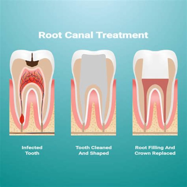 How many times can a root canal be retreated?