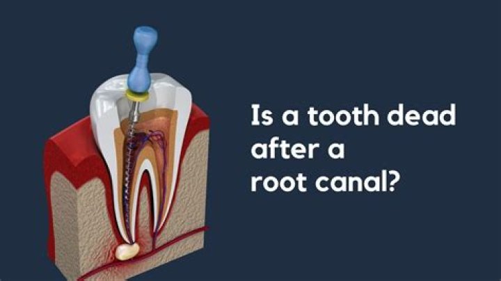 Why would you need a second root canal?